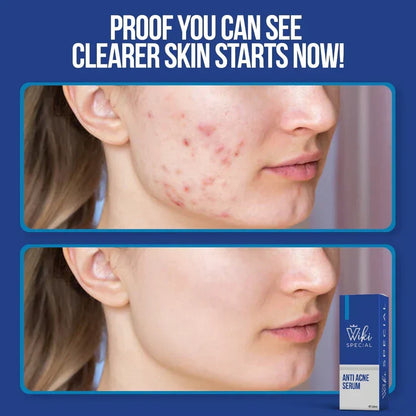 Wiki Special Anti Acne Serum
